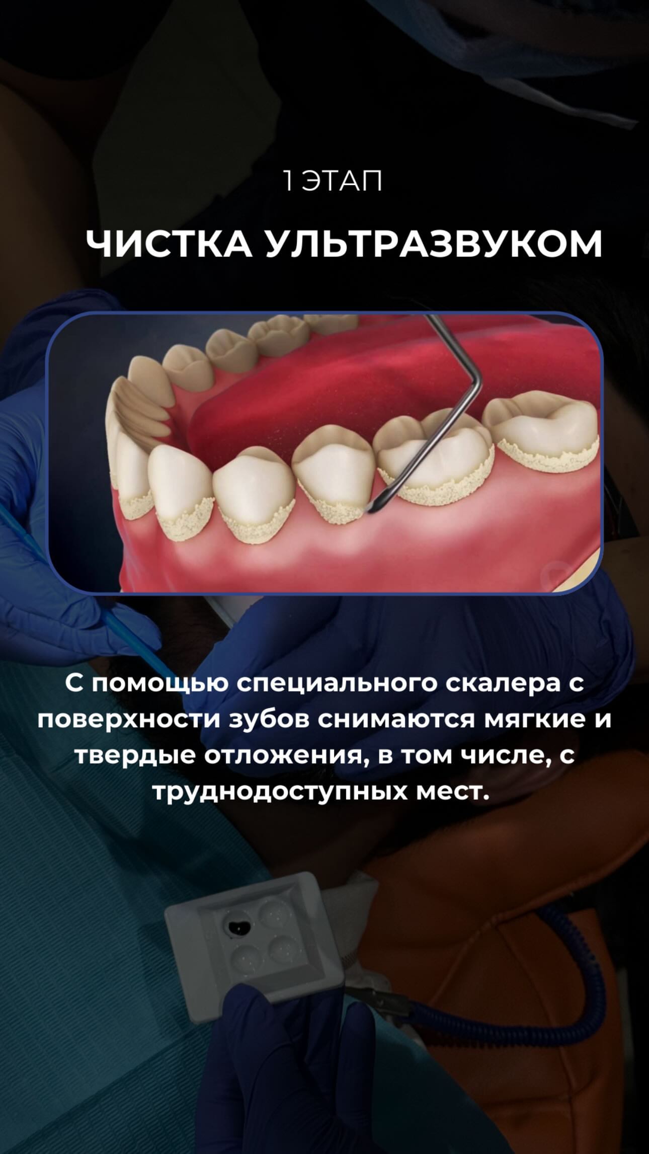 Имплантация